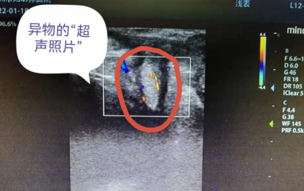 4歲女童陰道流血，一查竟發(fā)現(xiàn)異物